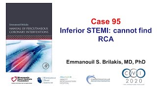 Case 95 PCI Manual  STEMI and unable to engage [upl. by Norby245]