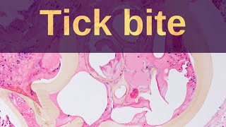 Tick Bites  Pathology mini tutorial [upl. by Atenek]