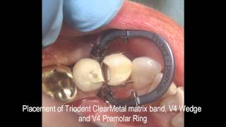 Clinical Case Study of Class II Restoration Tooth 21 ADA 34 FDI By Dr John C Comisi [upl. by Aniral]