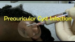 Preauricular Cyst Infection Management [upl. by Aikim]