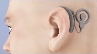 Cochlear Implant Animation [upl. by Daisy227]