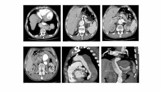 Chirurgie ouverte des anévrismes de l’aorte [upl. by Grace]