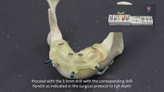 Straumann® Guided Surgery System and Straumann® BLT [upl. by Ultima755]