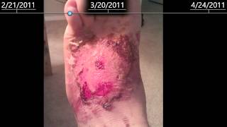 2nd Degree burns on foot  healing time lapse  2 months [upl. by Edora]