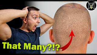 The Truth About Head Shaving After 2 Hair Transplants [upl. by Calista822]