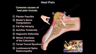 Heel Pain causes and treatment plantar fasciitis diagnosis and treatment [upl. by Siulegroj]