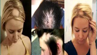 Causas de la Alopecia Femenina [upl. by Aiyn]