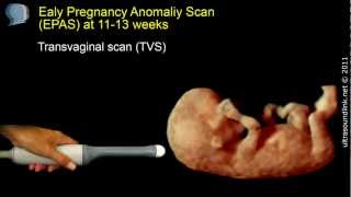 The 12 week scan transabdominal and transvaginal ultrasound [upl. by Moir]