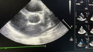 Bicuspid Aortic Valve [upl. by Gaye]