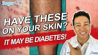 12 Diabetic Skin Problems amp Top Signs of Diabetes on The Skin [upl. by Airel154]