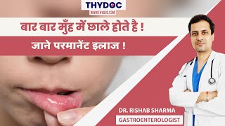 मुँह के छाले ठीक करने के घरेलु उपाय Mouth Ulcer Ka ilaaj Mouth Ulcer Kyu Hota HaiDrRishab Sharma [upl. by Erodisi]