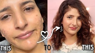 How to get rid of acne scars and acne acnetreatment pimple homeskincare [upl. by Bonny]