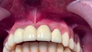 Minor Oral Surgery  Periapical cyst removal and apicectomy surgery for radicular cyst [upl. by Gujral533]