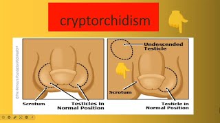 Cryptorchidism [upl. by Patterson]