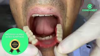 PRÓTESIS DENTAL parcial flexible alta estética PREMIUM999 [upl. by Siusan]