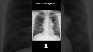 Anterior mediastinal mass  Thymoma 85 chest x ray Quiz radiologychannel007 [upl. by Nnaecyoj]