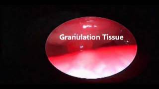 Tracheostoma Granulation Tissue Resection [upl. by Raseta815]