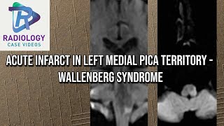 Acute infarct in left Medial PICA territory  Wallenberg syndrome [upl. by Otsenre]