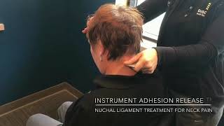 Nuchal Ligament treatment for neck pain [upl. by Norvall]