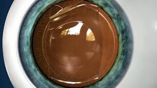 Vision Correction for High Levels of Myopia amp Astigmatism [upl. by Rani800]