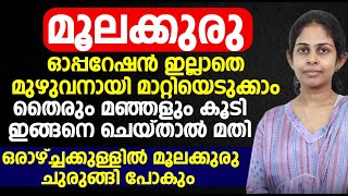 മൂലക്കുരു ഓപ്പറേഷൻ ഇല്ലാതെ മുഴുവനായി മാറ്റിയെടുക്കാം [upl. by Pren]