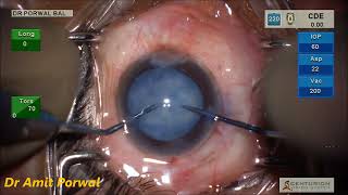 Dr Porwal Phaco Mature Intumescent Cataract Pre Chop [upl. by Ilzel]