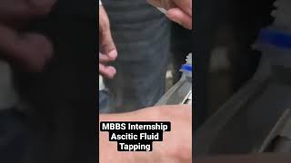 MBBS Intership  Ascitic Fluid Tapping  DrGarima  MisMedicine shorts viral shortvideos [upl. by Crofoot]