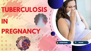 Tuberculosis in Pregnancy Causes Symptoms Diagnosis Treatment and Pathology  TOG Article [upl. by Jariv405]