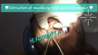 Buccal to lingual motion maxillary 2nd premolar extraction with double curvatures Sshaped roots [upl. by Silas184]