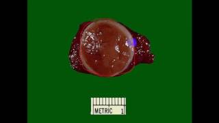 Pathology  dr Nafea  Thyroid Tumors باثولوجي الغدة الدرقية [upl. by Mikael]