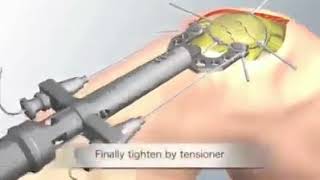 Comminuted Patellar Fracture [upl. by Zaraf]