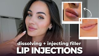 LIP INJECTIONS Dissolving and reinjecting lip filler process  all you need to know [upl. by Elle748]