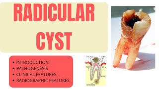 RADICULAR CYST MADE EASY PART 1 [upl. by Ennoved518]