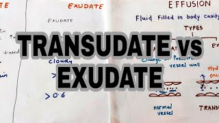 Transudate vs Exudate  Types of effusion  lights criteria [upl. by Jennica778]