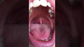 Palatal Myoclonus Update Re Medication [upl. by Yroffej]