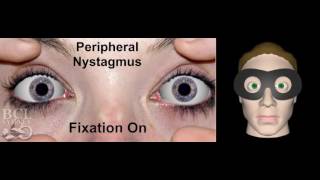 Nystagmus  The Effect of Visual Fixation [upl. by Millman]