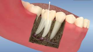 Root canal treatment and post core application [upl. by Mirth]