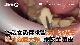 25歲女恐懼求醫滿口牙結石 比牙齒還大顆 網友全嚇歪 25の女性歯医者恐怖症治すついでに歯石取ってくれた！超大量歯石！ 療癒 [upl. by Edac]