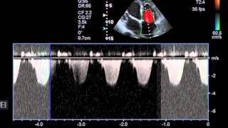 Myocarditis [upl. by Dahsar]