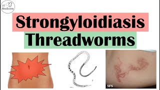 Strongyloidiasis Threadworms  Causes Pathophysiology Signs and Symptoms Diagnosis Treatment [upl. by Davey]