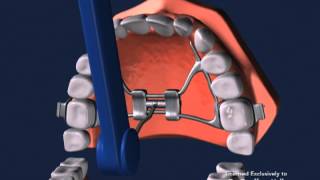 Advanced Orthodontics  Expanders [upl. by Sagerman]