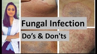 Fungal infection of skin  Dos and Donts  Dermatologist  Dr Aanchal Panth [upl. by Mckale]