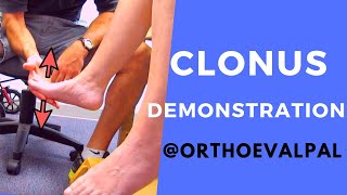 Clonus Demonstration with Ortho Eva Pal [upl. by Ema]