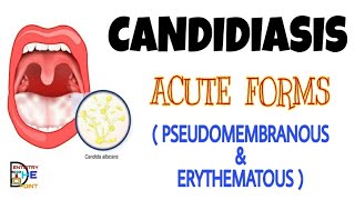 CANDIDIASIS  ACUTE FORMS  PSEUDOMEMBRANOUS amp ERYTHEMATOUS [upl. by Anaerdna966]