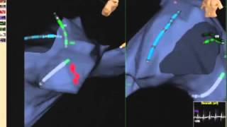 Electrophysiological Study amp Catheter Ablation [upl. by Featherstone]