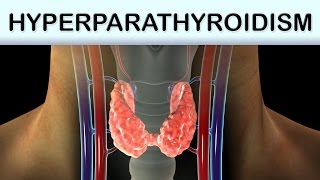 Hyperparathyroidism Medical Animation [upl. by Nevs]