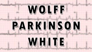 WolffParkinsonWhite Syndrome [upl. by Berri]