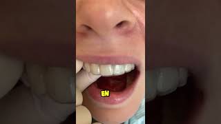 un implante dental es mejor que un diente natural dientes dentista tips parati viral fyp [upl. by Aurel438]