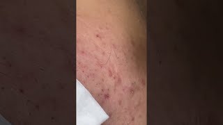 Big Cystic Acne Blackheads Extraction Blackheads amp Milia Whiteheads Removal Pimple Popping shorts [upl. by Novled159]