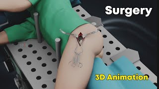 SuperPath Hip Replacement Surgery  3D Animation [upl. by Ahsennod252]